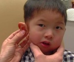 four-year-old-boy-is-given-a-very-lifelike-printed-ear-prosthetic-3